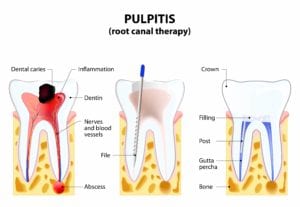 root canal process