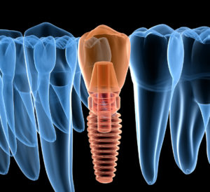 xray of a dental implant in the jaw