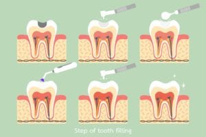 steps of a dental filling