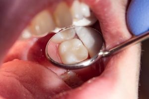 dental mirror showing the bottom of a tooth