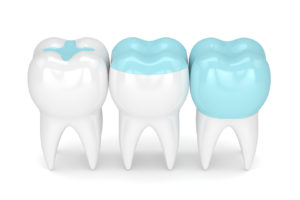 graphic of different ways a tooth can be fixed