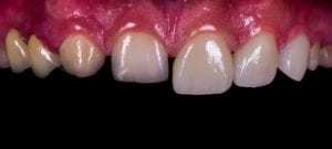 veneer tooth before and after