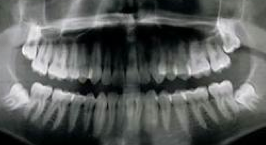 xray of a mouth