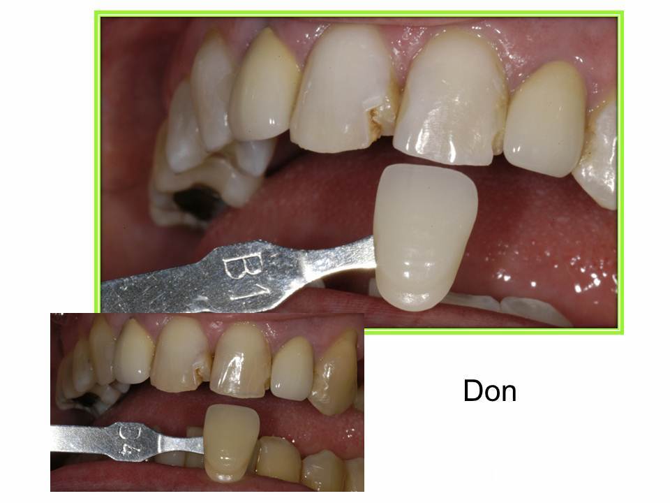 matching veneer color to tooth