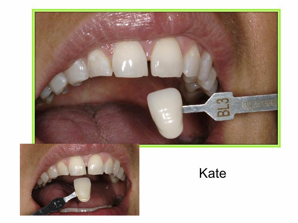 matching veneer color to tooth