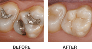 CEREC before after image