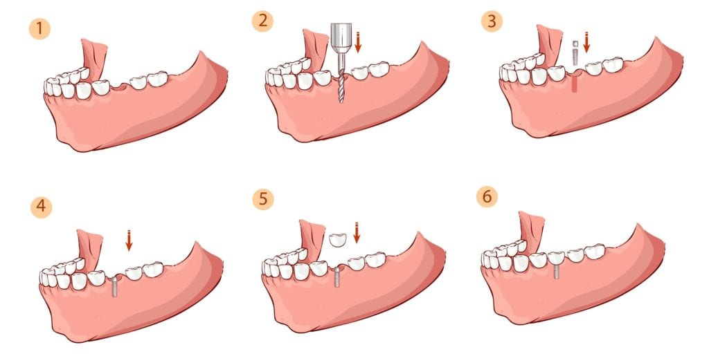 steps of dental implant placement