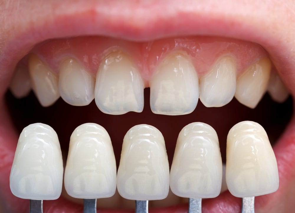 Veneers shown under original smile