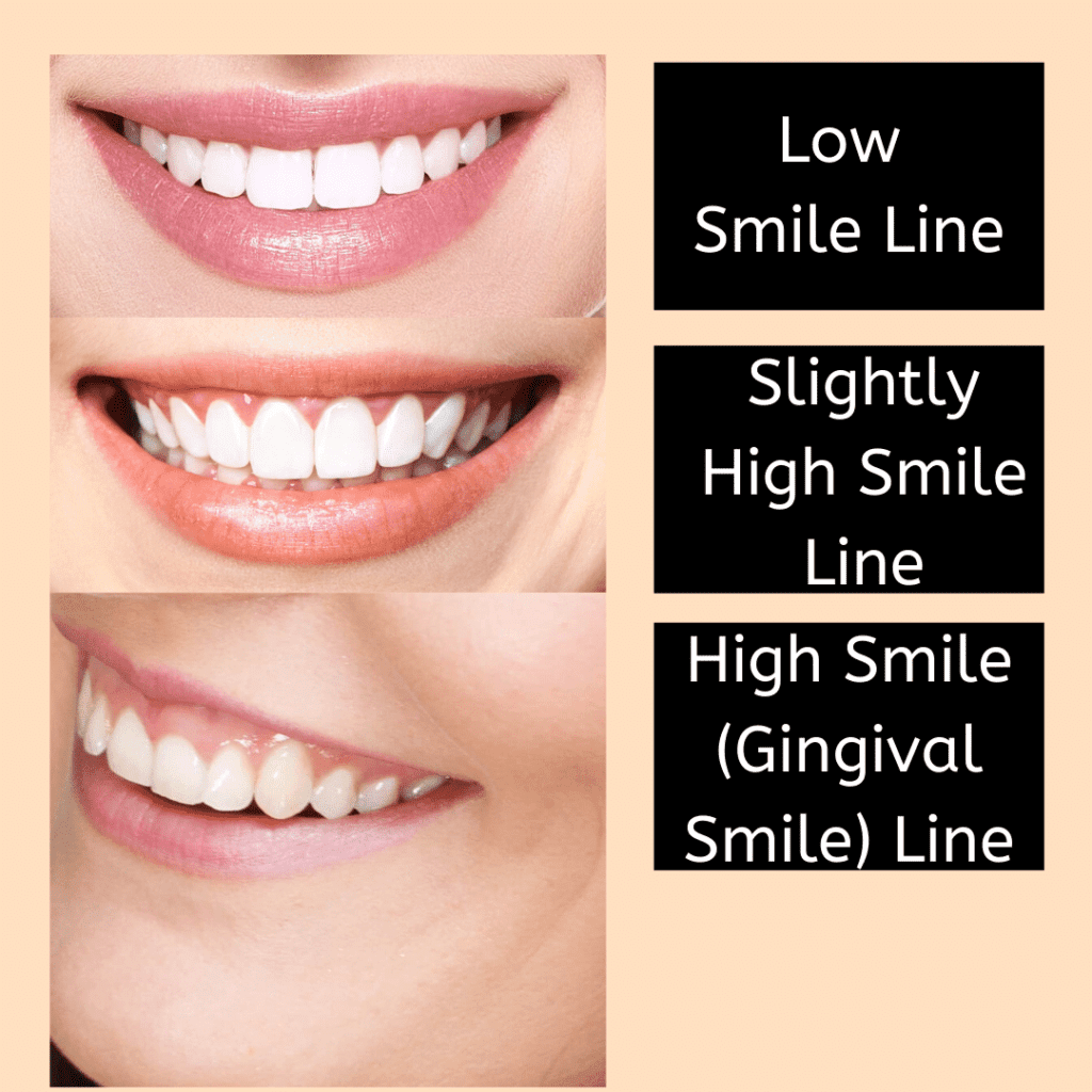 smile lines
