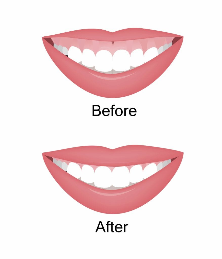 Before and after gum contouring surgery

