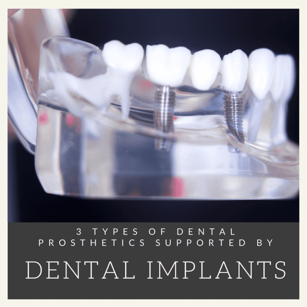 3 Types of Dental Prosthetics Supported by Dental Implants