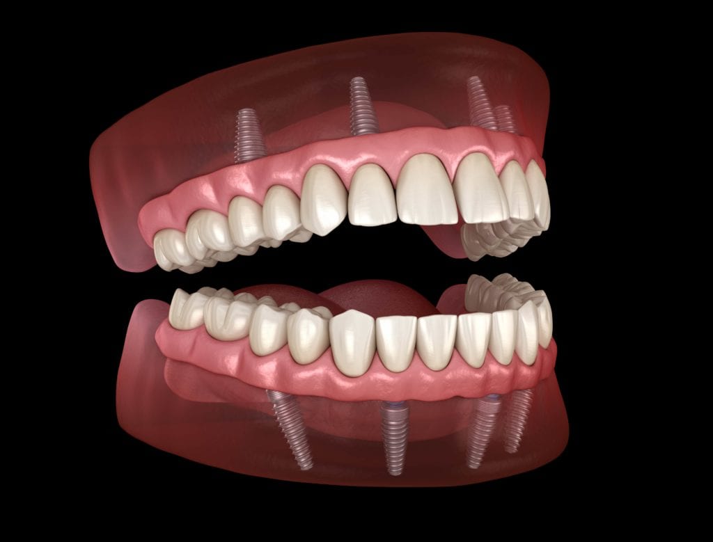 implant-supported denture