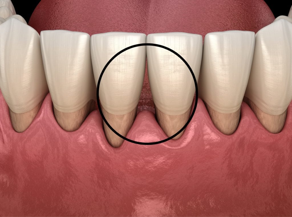 gum recession creating a black triangle between the teeth