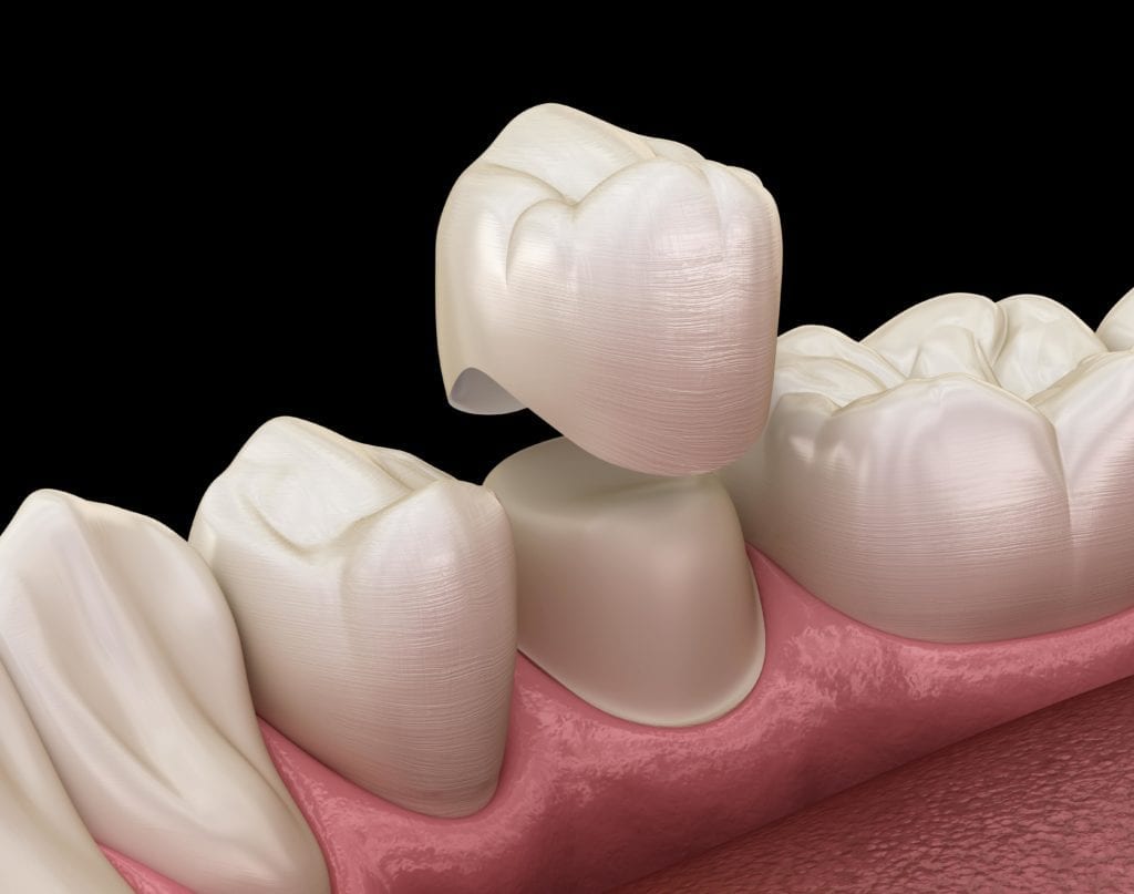 Dental crown being placed over tooth