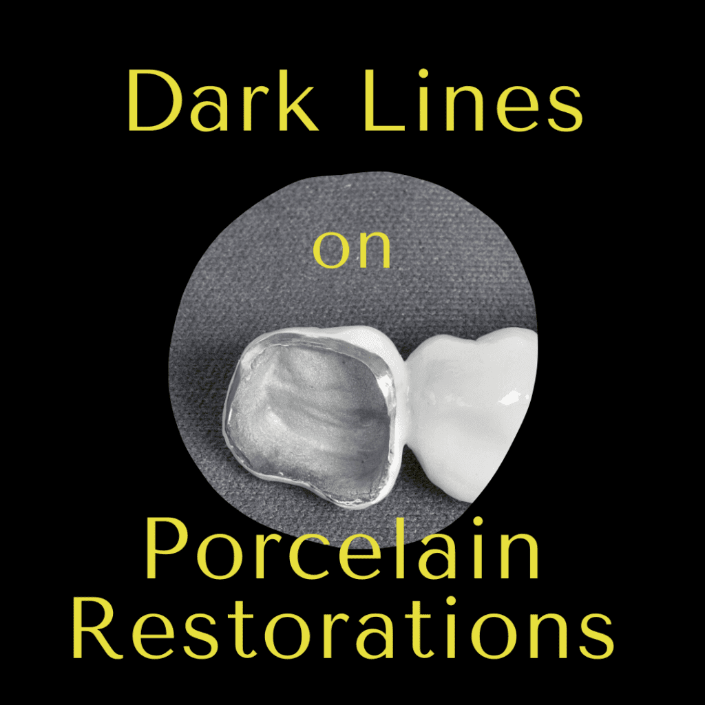 Dark Lines on Porcelain Restorations