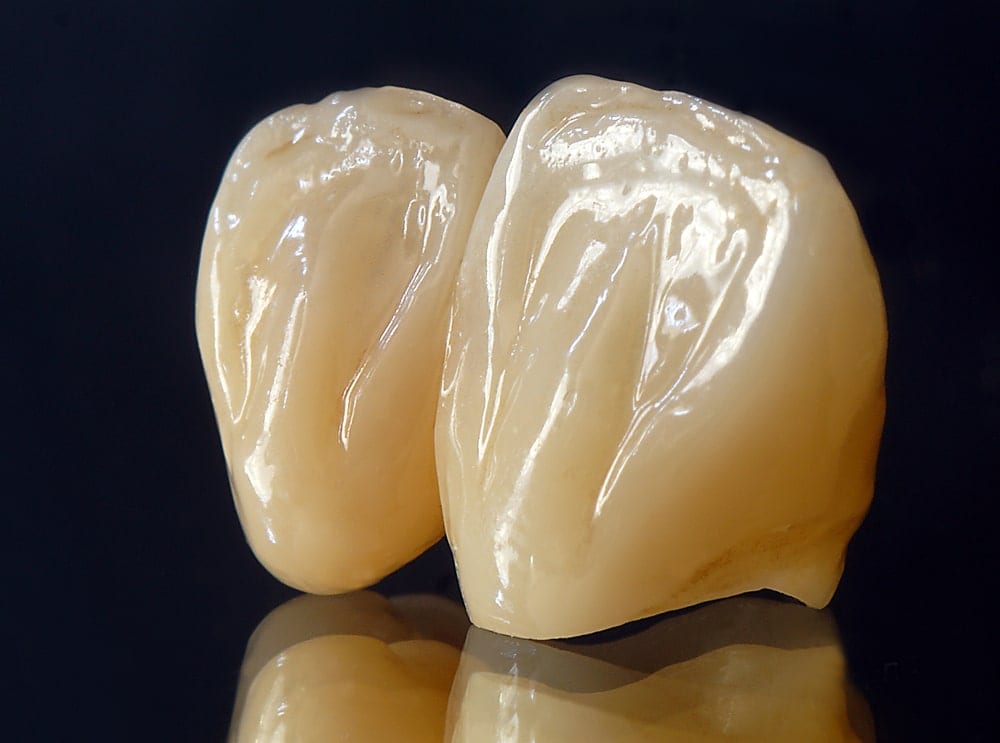 all porcelain crowns