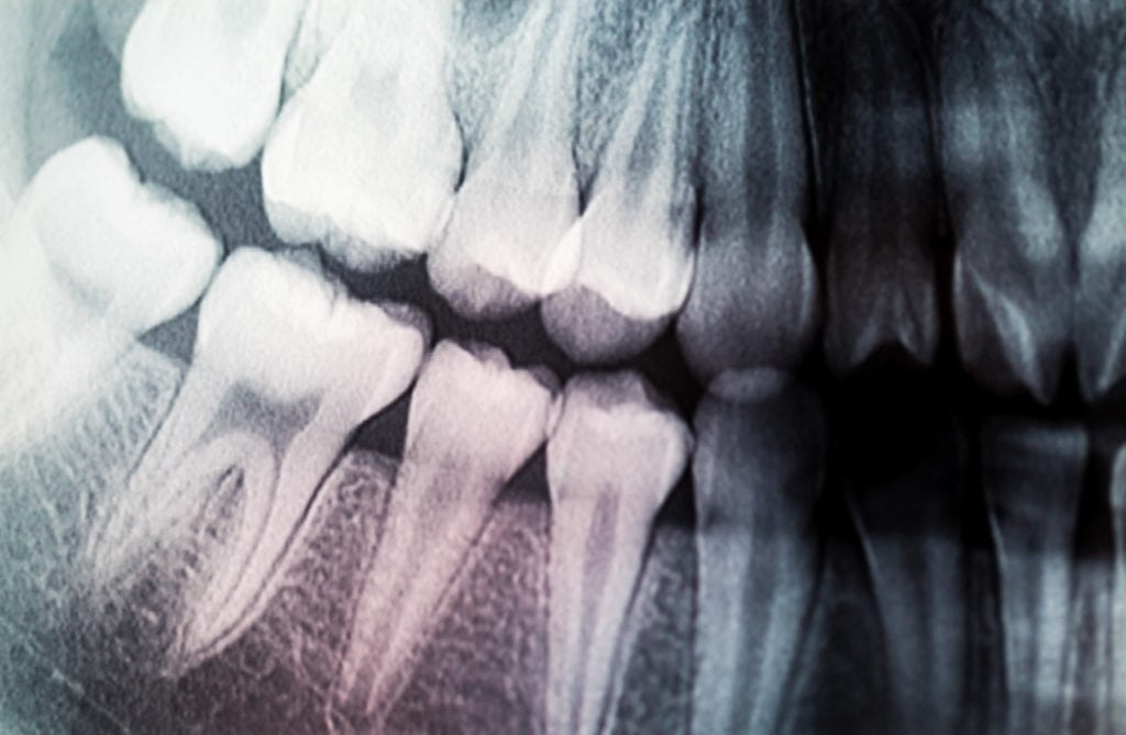 dental x-ray of teeth