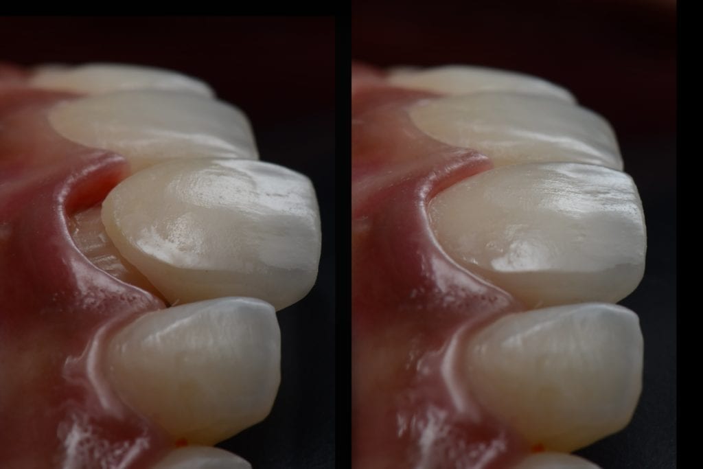 gum recession exposing dental restoration