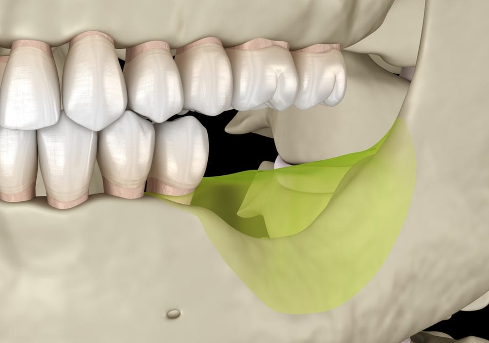 Bone resorption occurring in jawbone