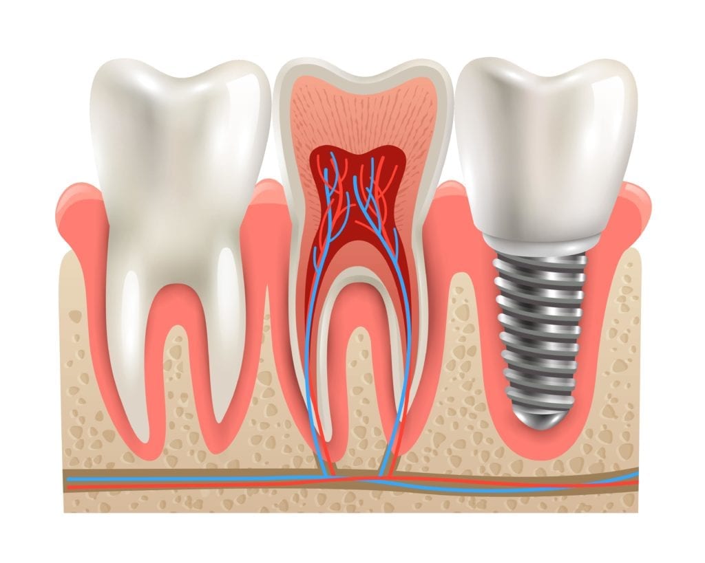 dental implant next to natural teeth