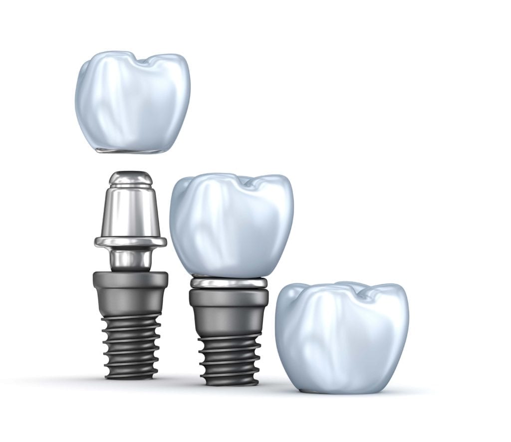 dental implants