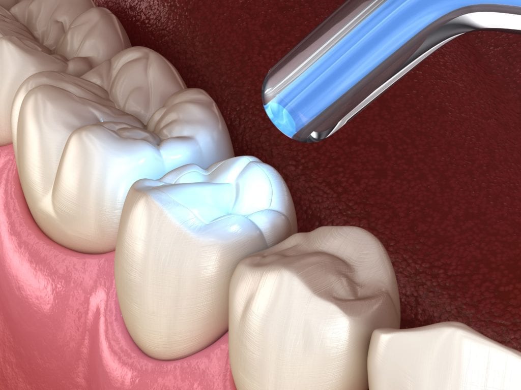 composite filling being hardened with a curing light