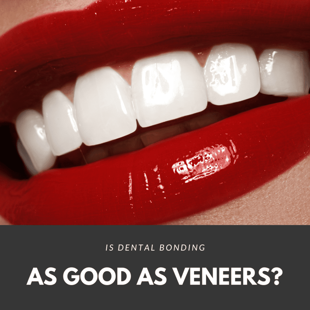 Is Dental Bonding as good as veneers3
