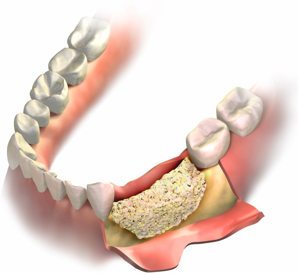bone graft in jawbone