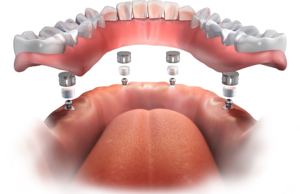 implant-supported denture