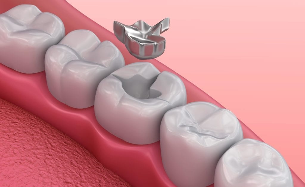 metal filling shown being placed in tooth