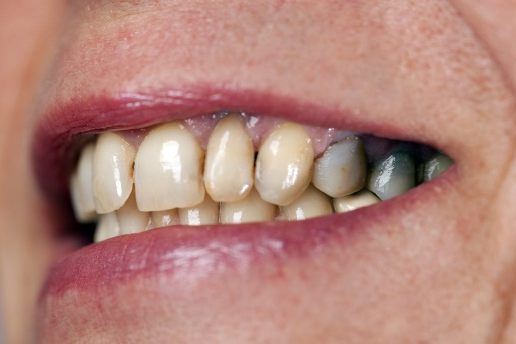 teeth stained from metal fillings