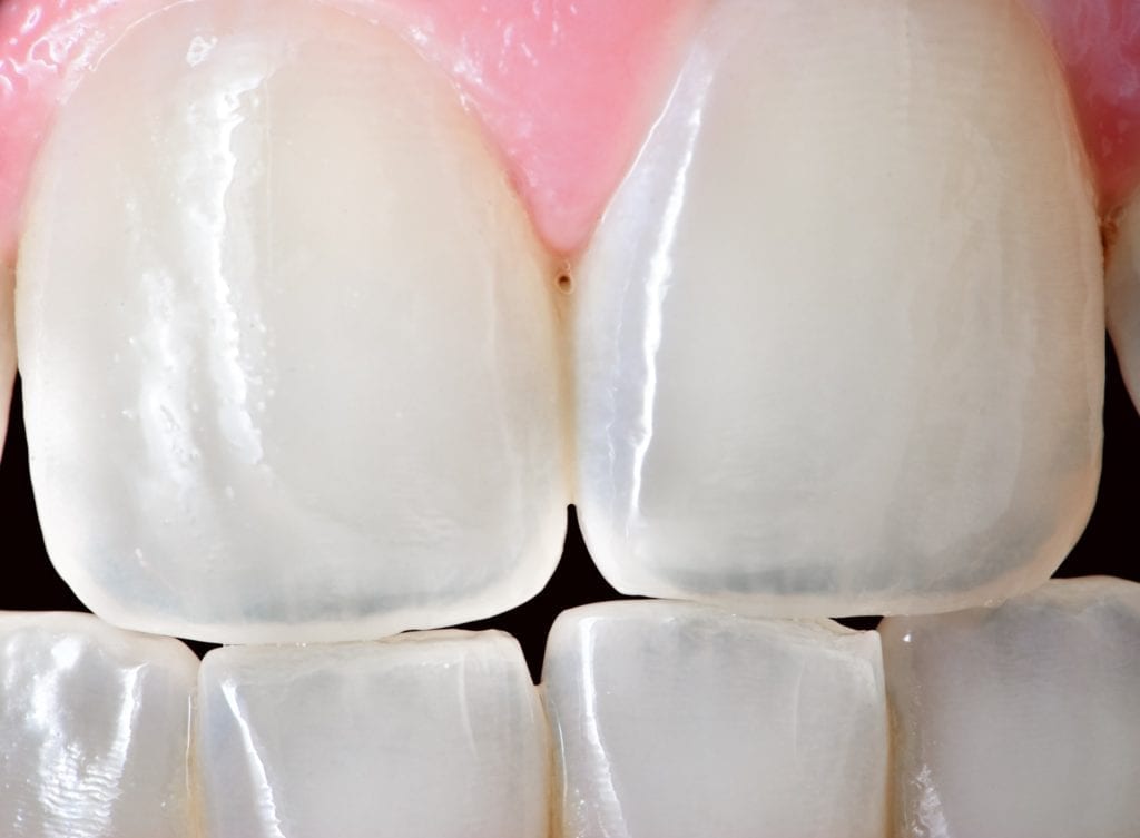 closeup of teeth with translucent tips