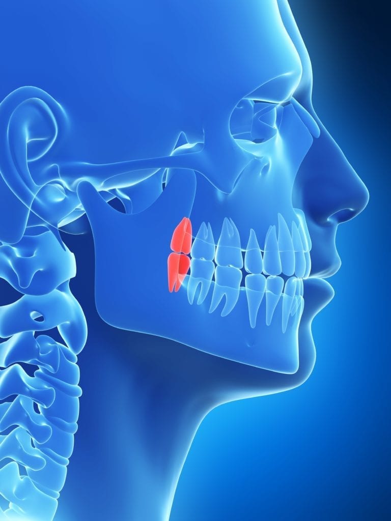 impacted wisdom teeth