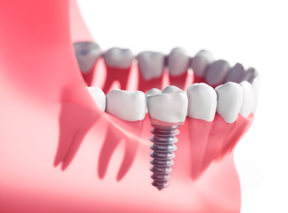 dental implant in jaw