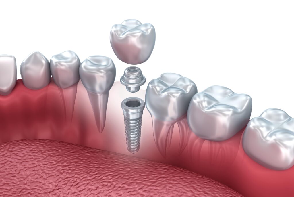Dental implant in pieces shown next to natural teeth