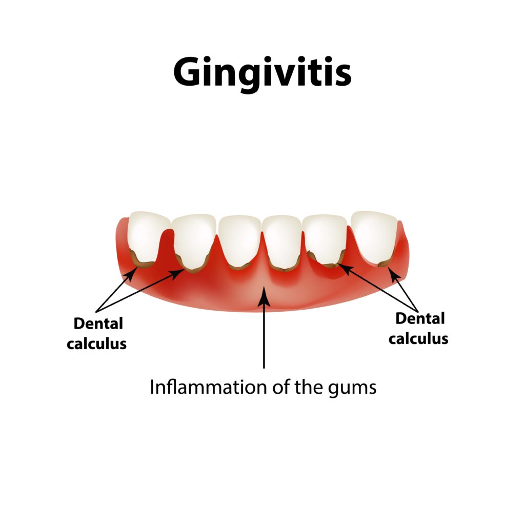 5 Reasons Why Your Gums are Bleeding - Empire Dental