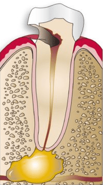 severe tooth decay