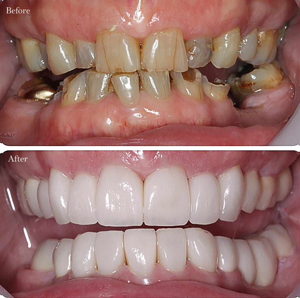 decayed teeth before and after dental crown
