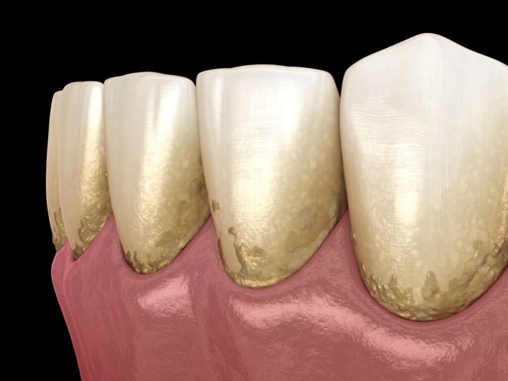 plaque on teeth