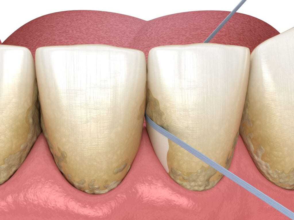 flossing between teeth