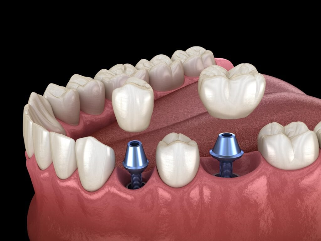 Dental implants in gum