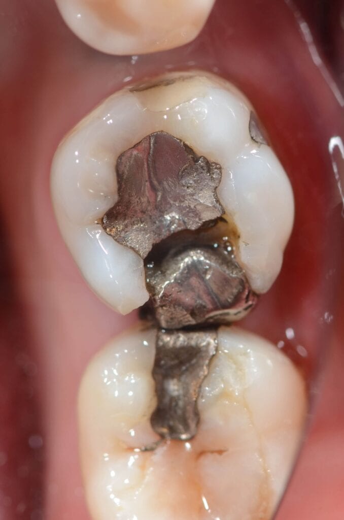 damaged amalgam filling 