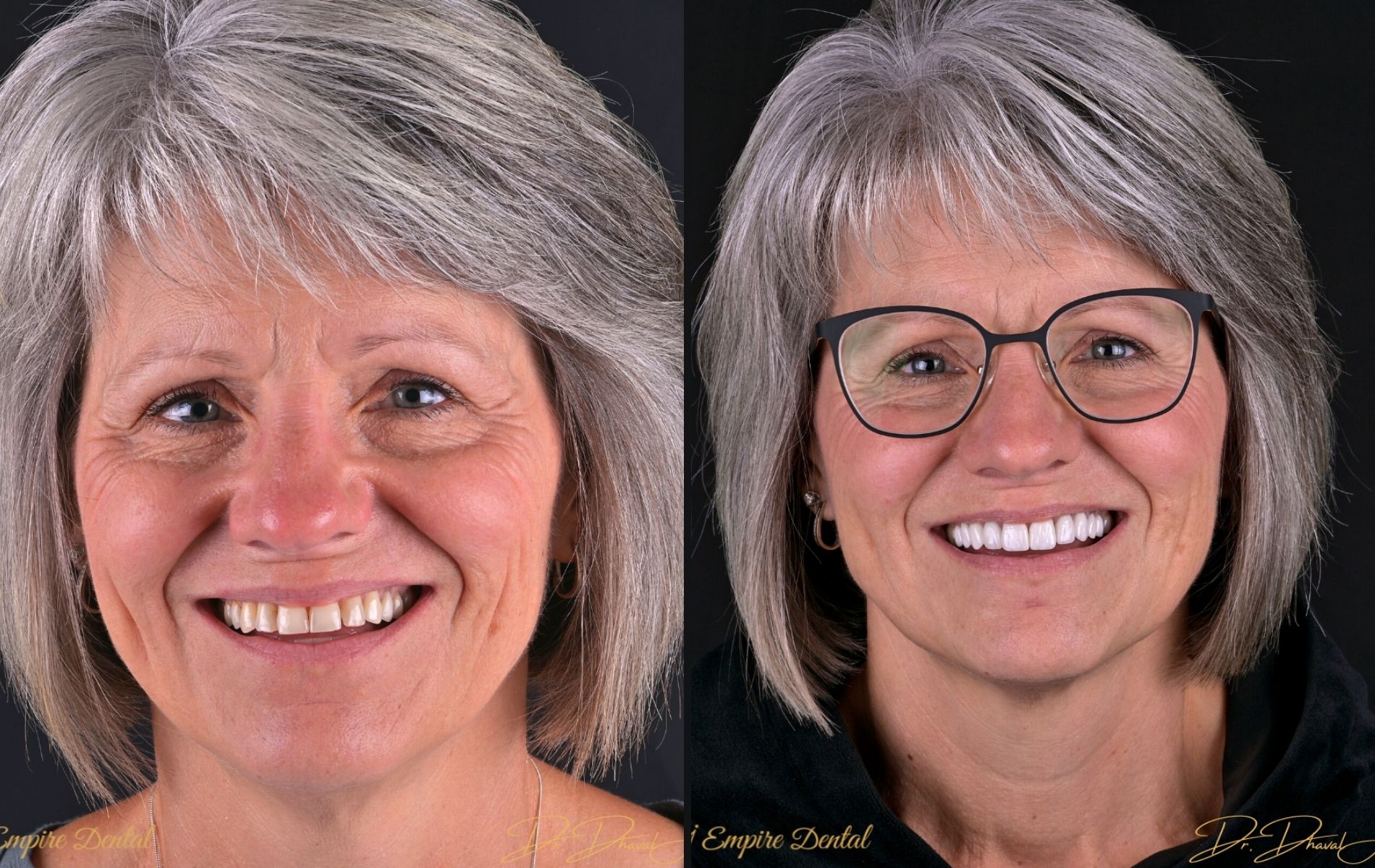 Empire Dental - Susan before and after
