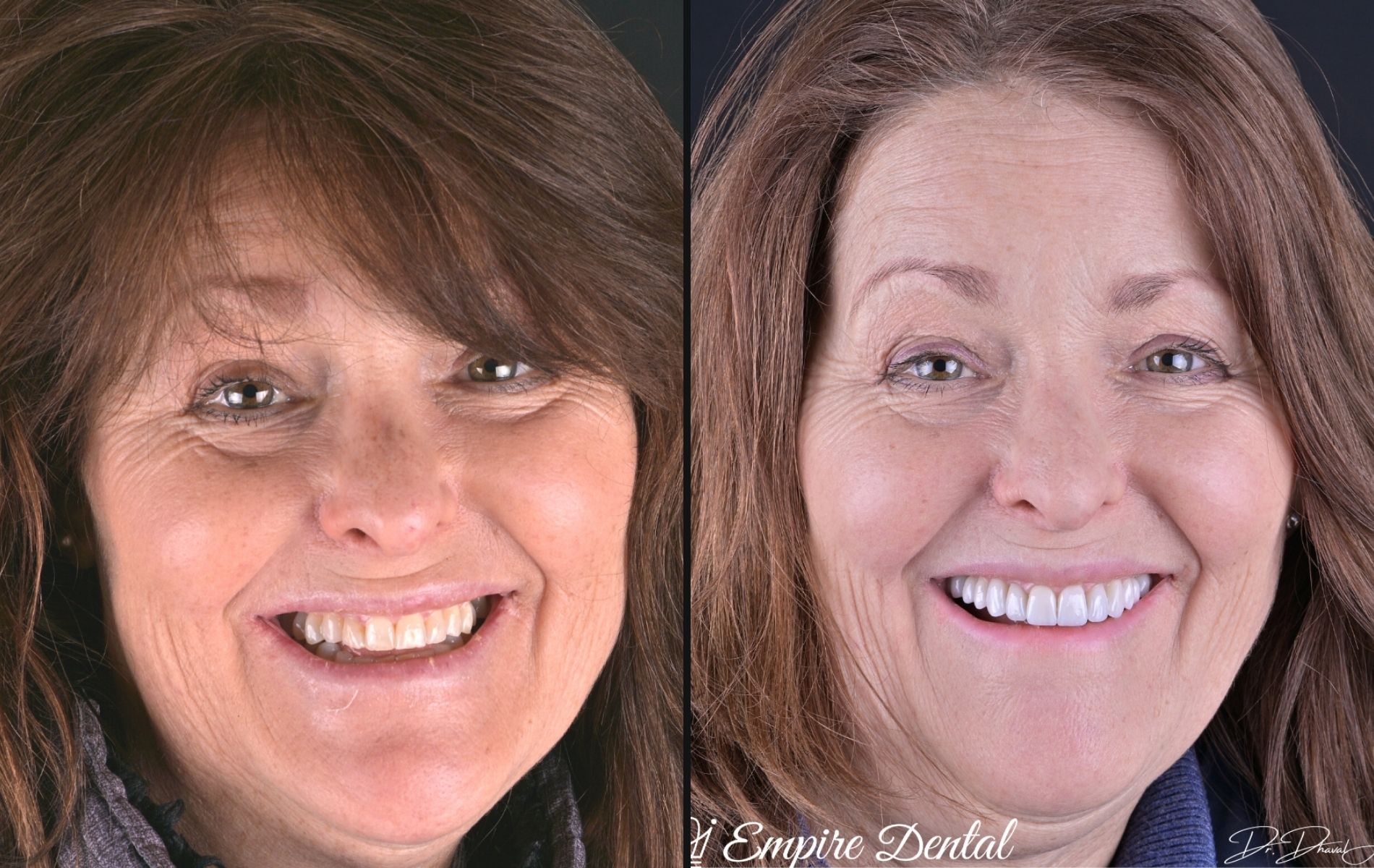 Empire Dental - Tracy before and after (1)
