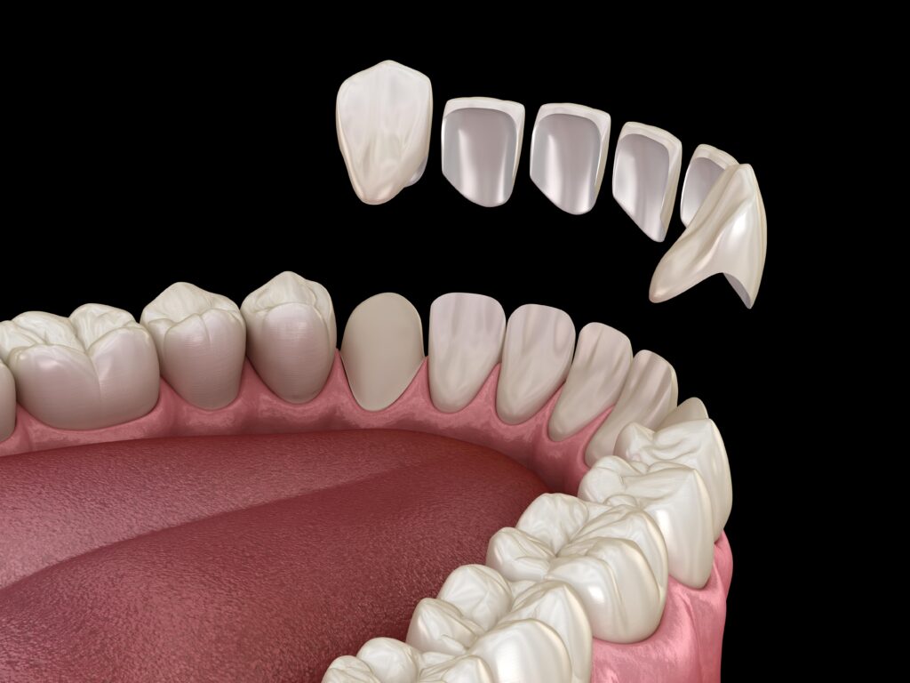 veneers on teeth