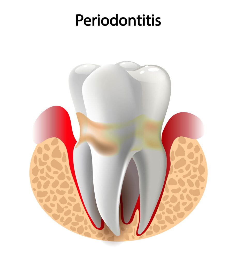 periodontitis