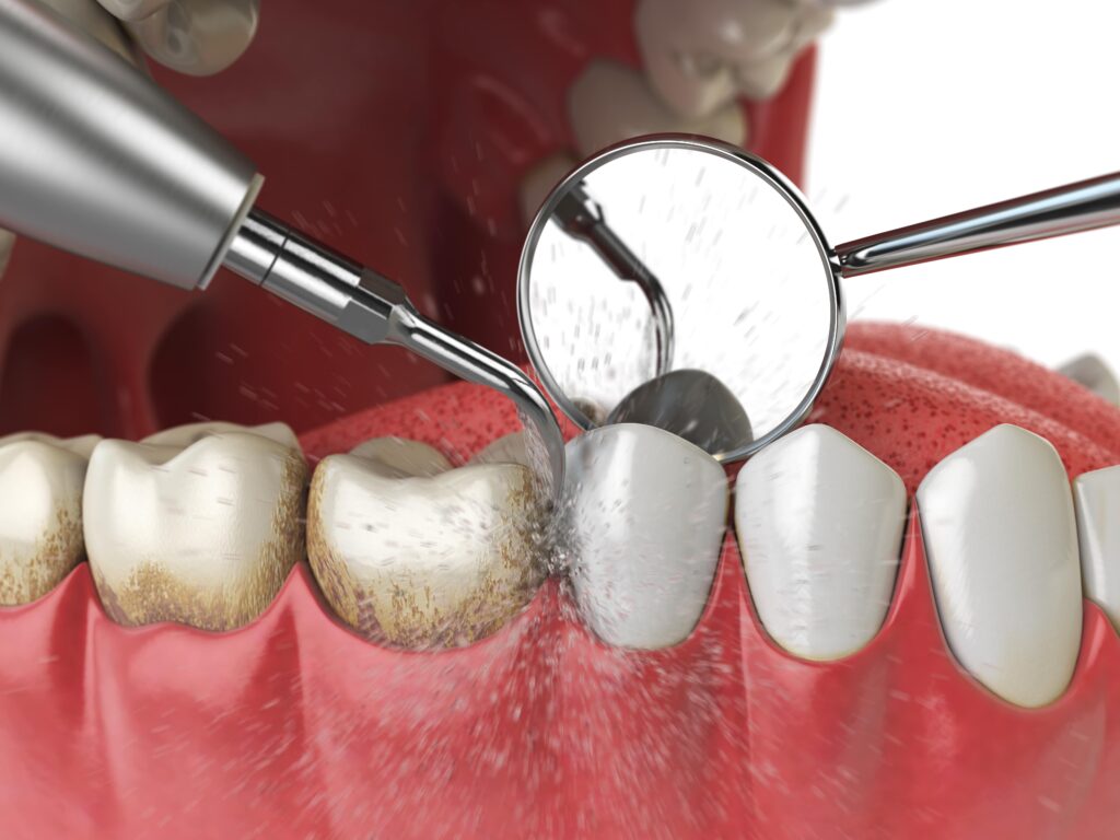 dental scaling