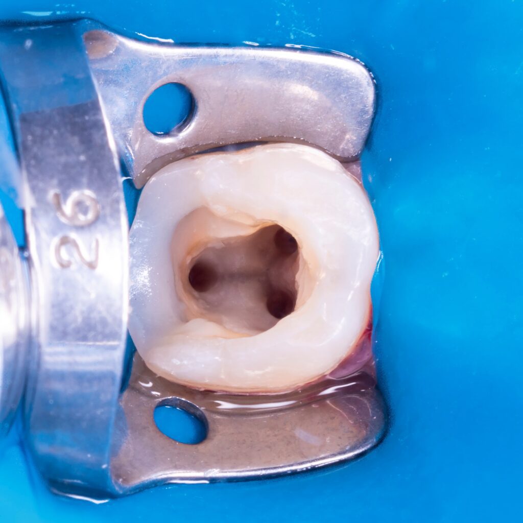 hollowed out tooth