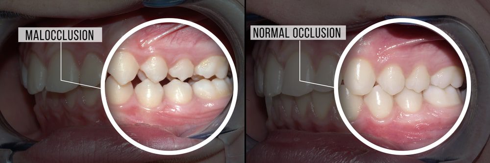 malocclusion vs normal occlusion