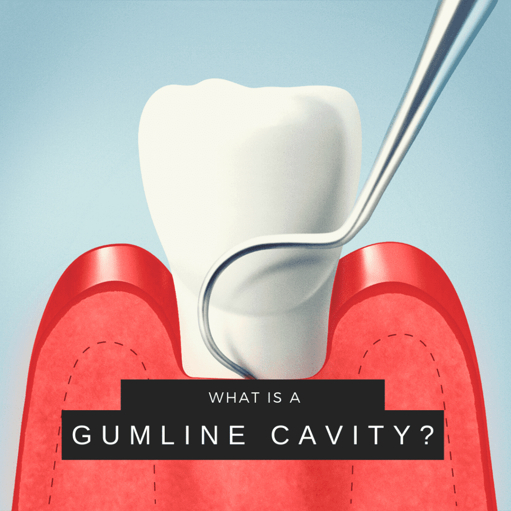 What is a gumline cavity